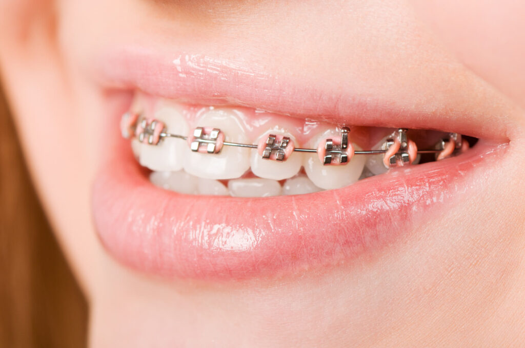 a child wearing braces after seeing an Orthodontist in Pearl City
