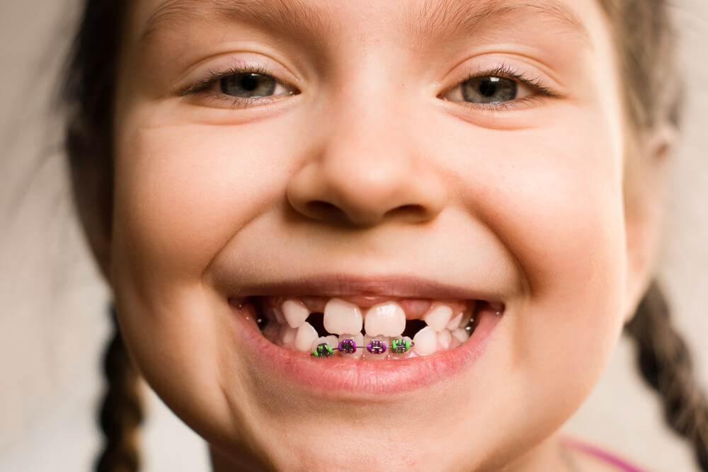 Child with crooked teeth with pearl city dental