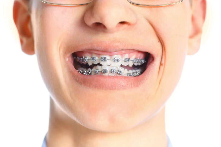 Close up with a child needing braces with pearl city dental