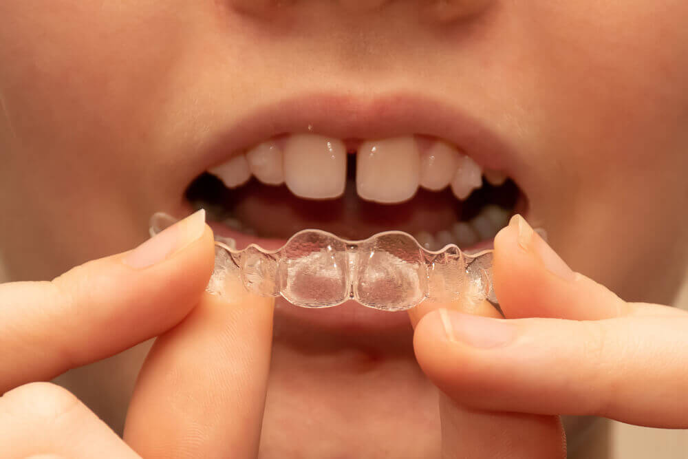 A child starting Invisalign in Pearl City for straighter teeth.