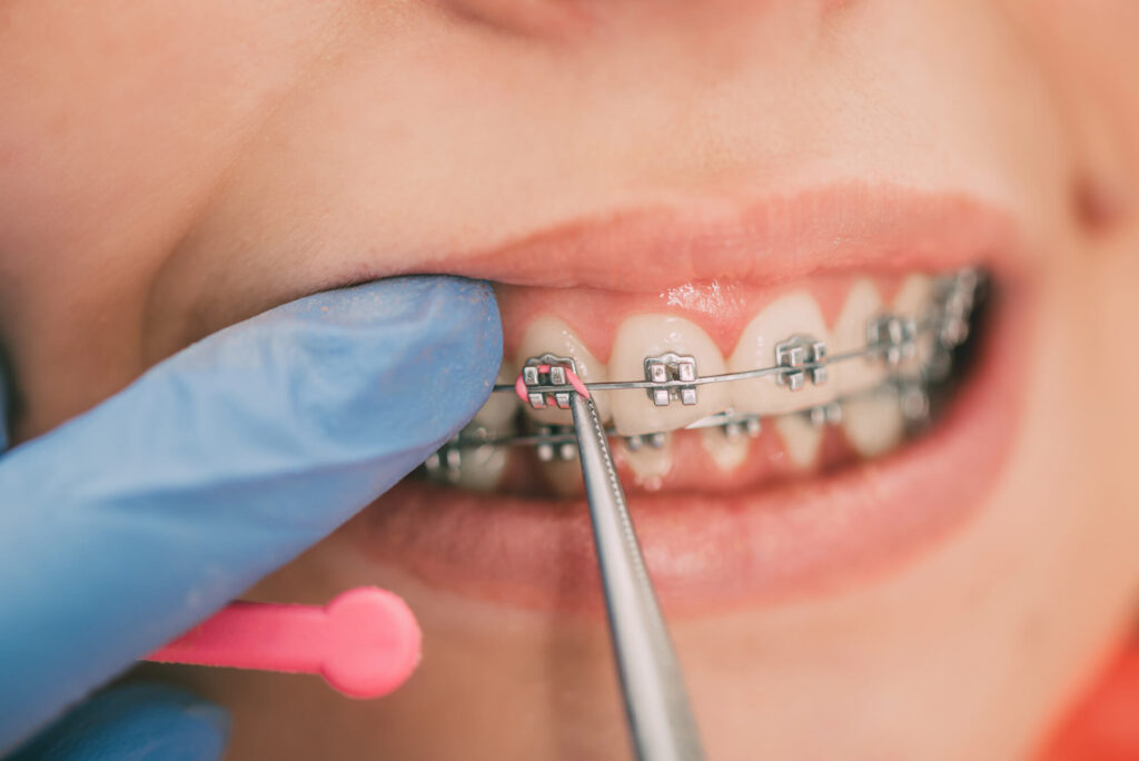 At What Age Should You Consider Kid Orthodontics in Kailua