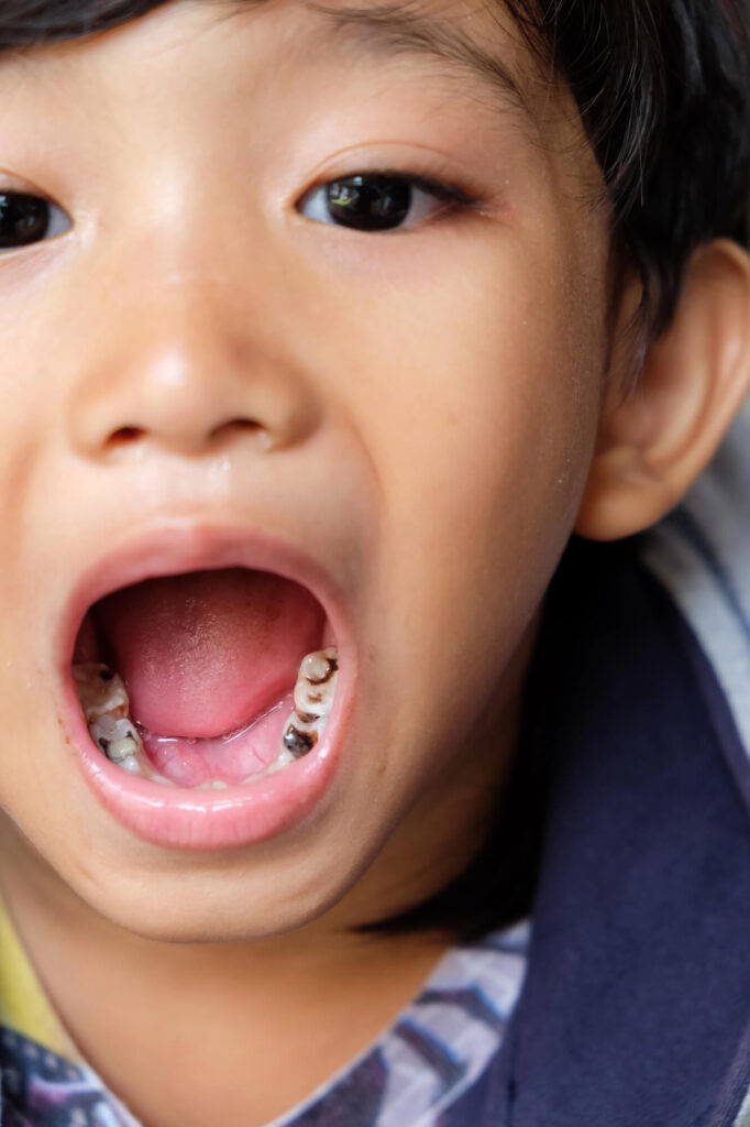 Pediatric Dentist in Honolulu Explains Why Kids Get Cavities