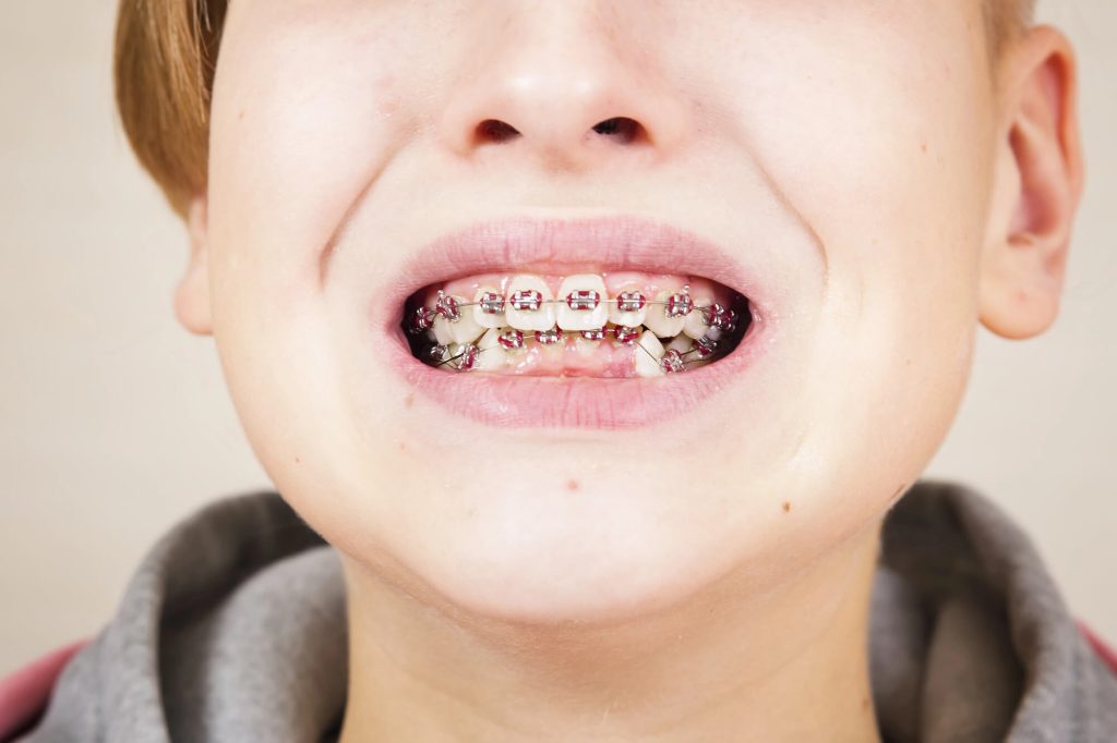 Challenges During Kid Orthodontics in Kailua