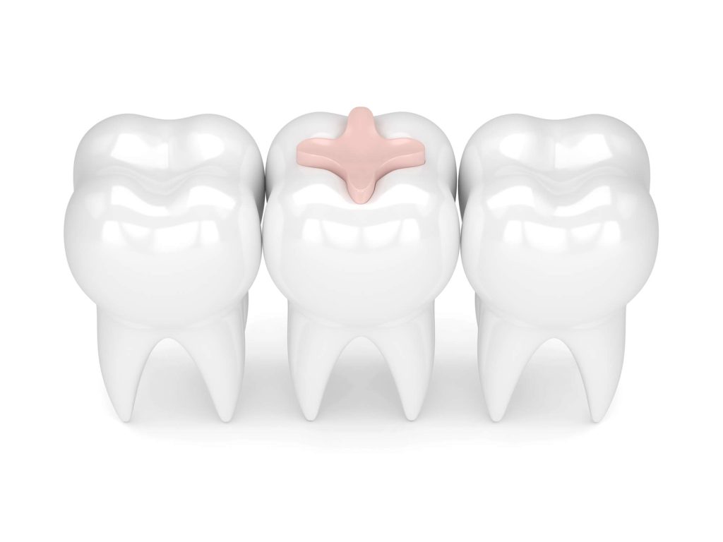 Illustration of Dental Sealants by a Kailua Pediatric Dentist
