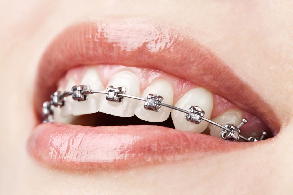 Is Pediatric Oral Surgery in Lihue Necessary Before Braces
