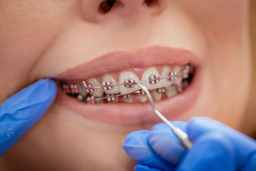 Orthodontist in Kapolei Adjusting Braces