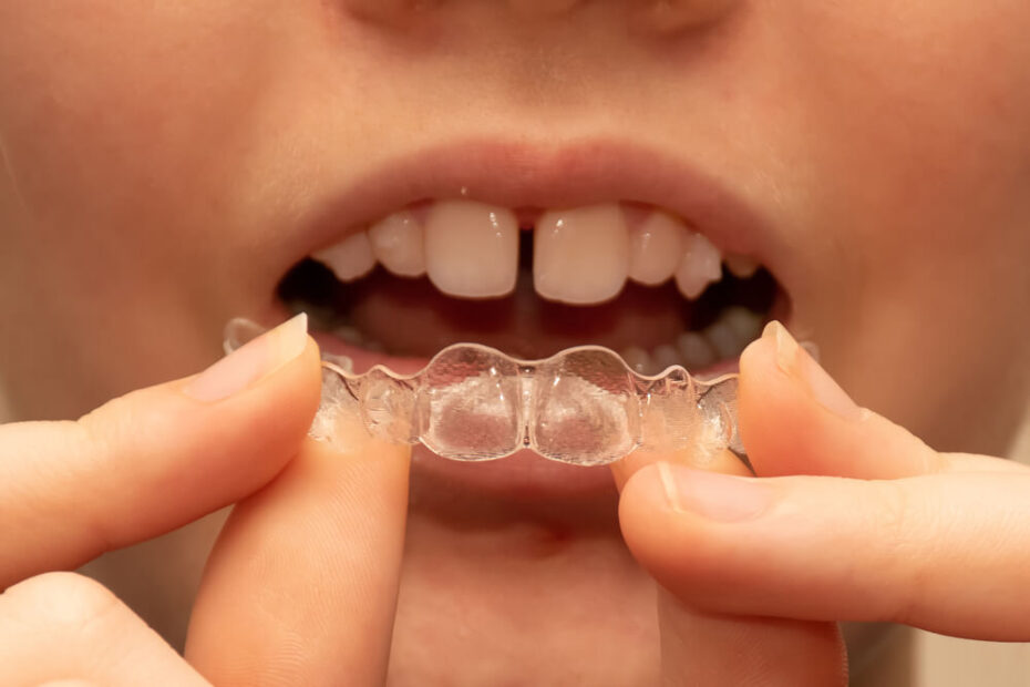 A child starting Invisalign in Kapolei for straighter teeth