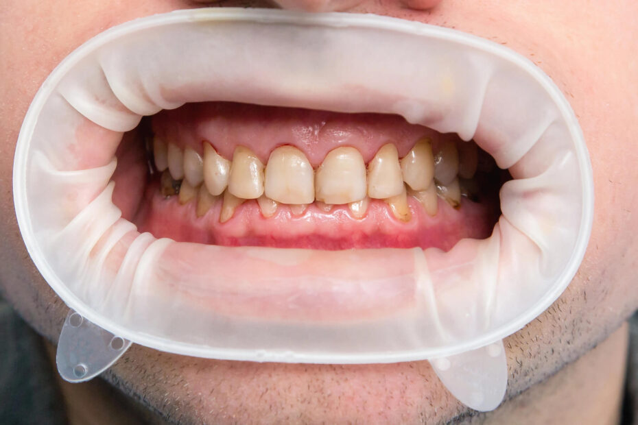 Prevent Fluorosis With a Dentist in Kapolei